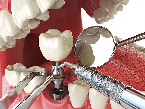 Best Emergency Dental Care for Broken or Chipped Teeth in Mcfarland, WI